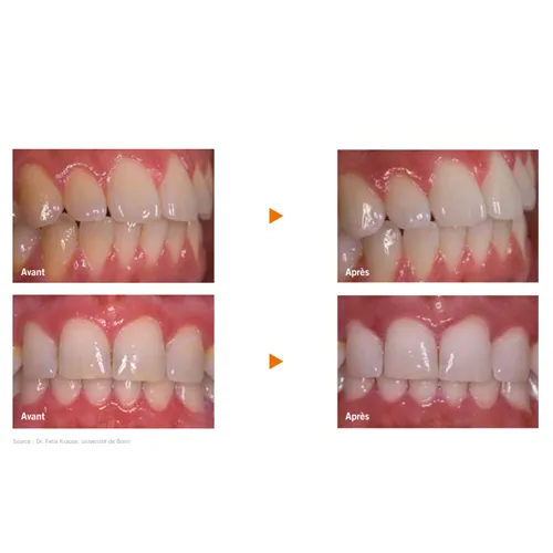 Perfect Bleach Blanchiment dentaire - VOCO